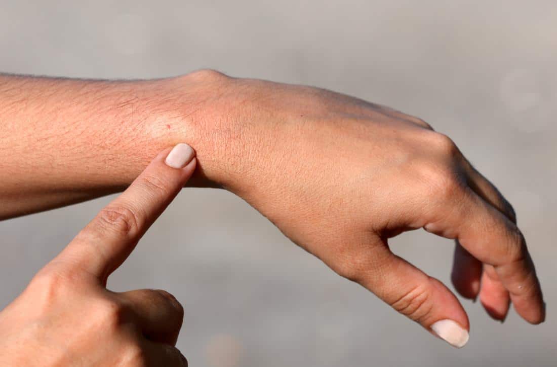 Bee Sting Allergy Reactions