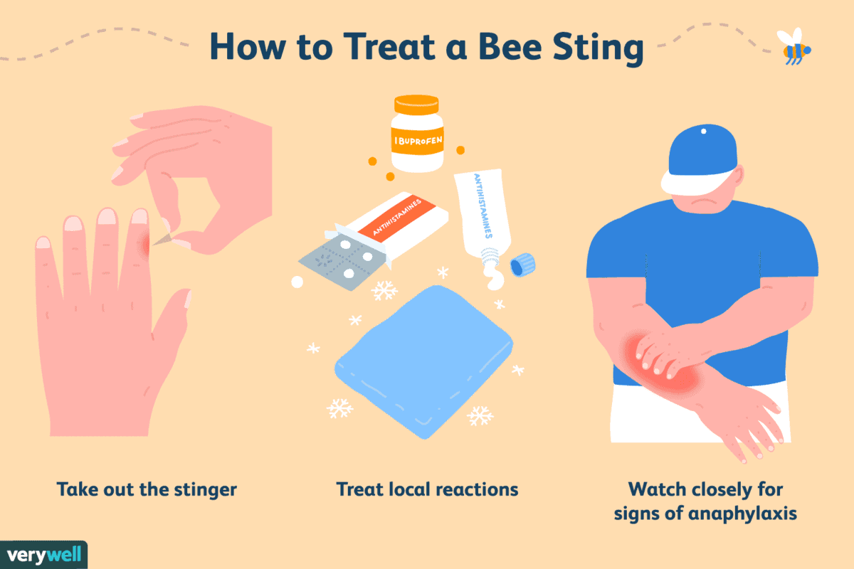 Prevention And Treatment Of Bee Stings