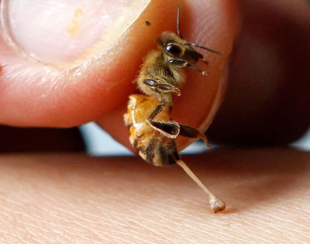 Treatment Of A Dead Bee Sting